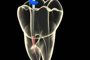 Endodontia | Dentista Uberlândia